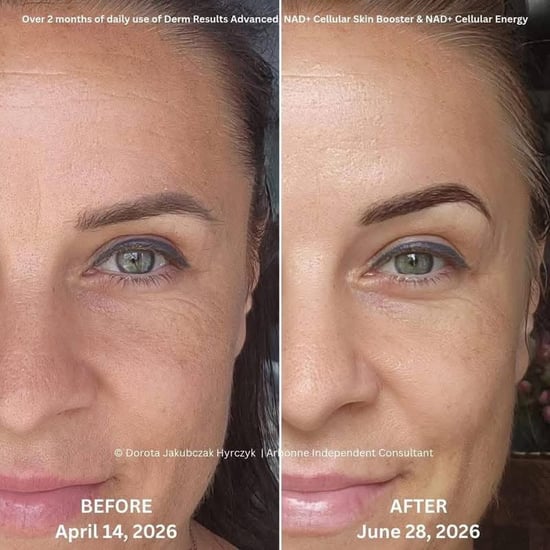 Before and after eye line reduction results