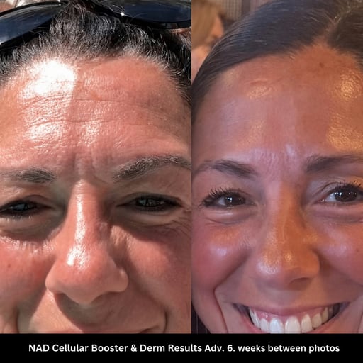No Botox No tape transformation
