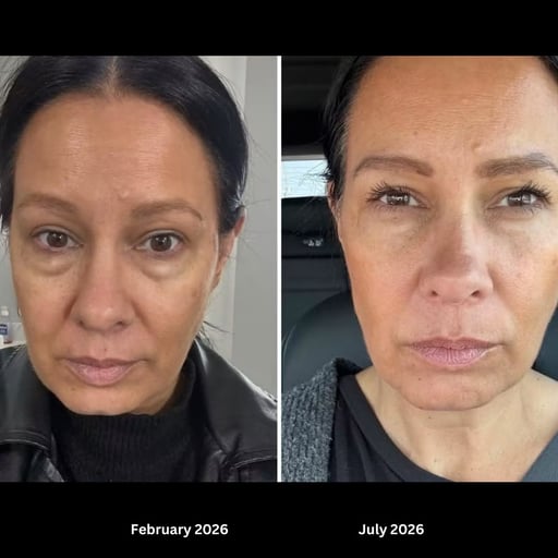 Under-Eye Transformation